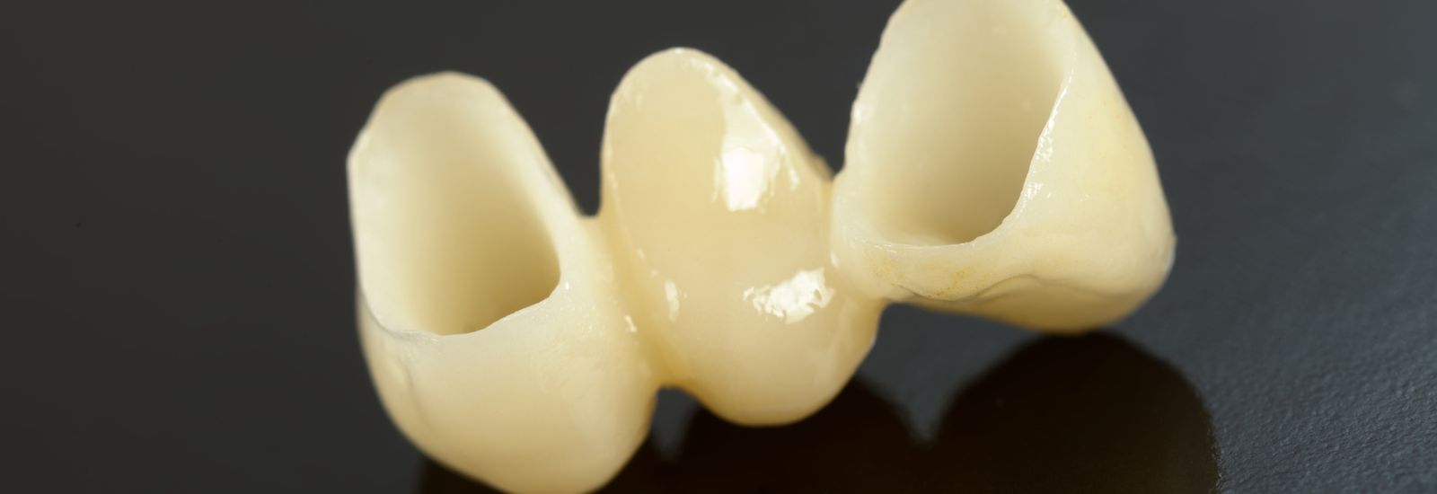 Pressed ceramic teeth - Dental bridge model